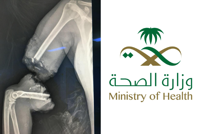 نجاة حامل وجنينها من حادث دهس: جراحو جدة يعيدون يدها للحياة بعد حالة بتر كاملة نجاة حامل وجنينها من حادث دهس: جراحو جدة يعيدون يدها للحياة بعد حالة بتر كاملة